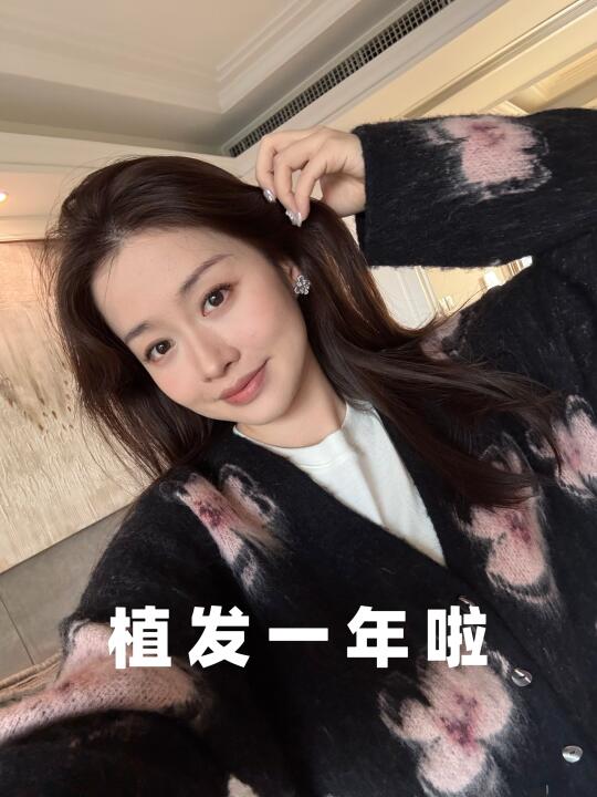 植发一年后的反馈来啦！终于get完美发际线