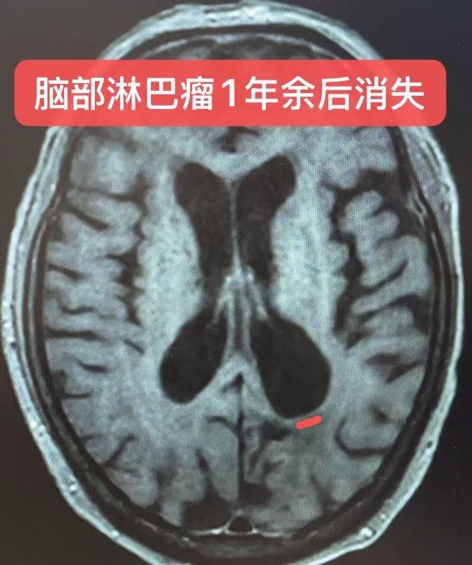 脑部淋巴瘤的治疗。脑部淋巴瘤：一般需要立体定向穿刺活检，该患者弥漫大B...