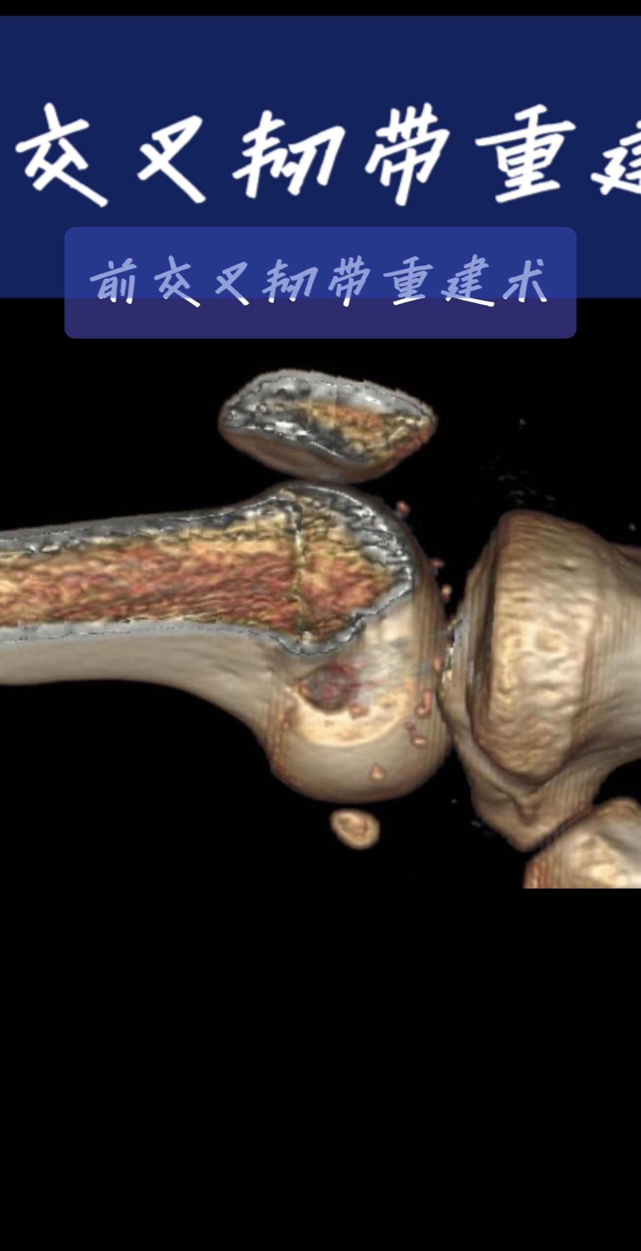 一台成功的前交叉韧带重建，关键在于“精准”二字。术后CT、MRI复查...