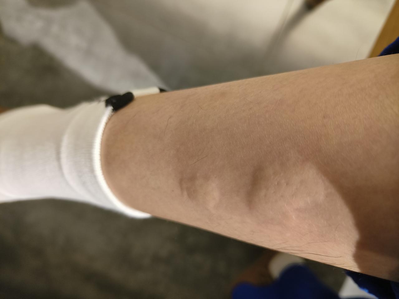 值得纪念一下，在北京的一个书店，每次去每次都被蚊子咬，这次包比较大，我就奇怪了，