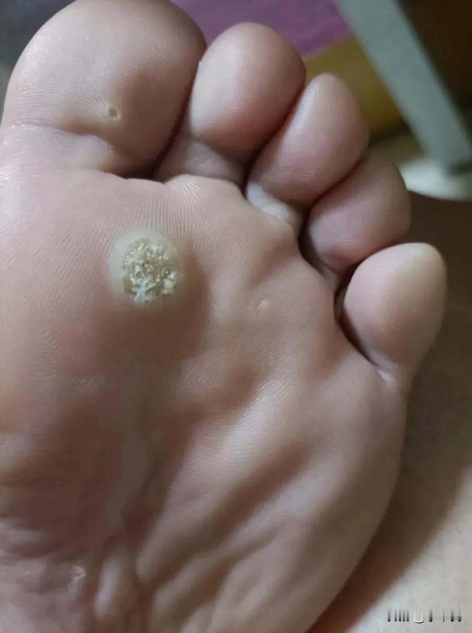 婆婆80多岁了，脚上长了好几个鸡眼，走路很疼，不想去医院了，大家有什么好方法吗？
