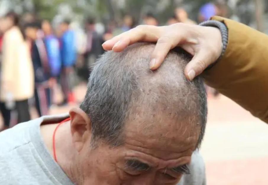 头部就是你的“血压仪”，若频繁出现这5种怪象，多半血压超标了

