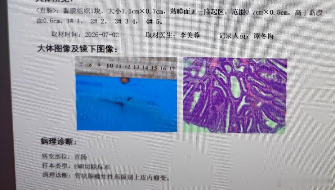 结直肠息肉伴高级别上皮内瘤变（HGIEN）一、诊断本质肠道腺瘤性息肉基础上发生重