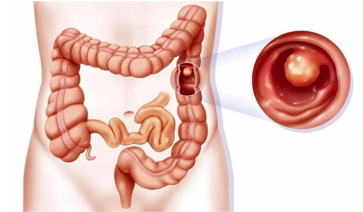 肠息肉，根不在肠道在脾胃，脾胃好了息肉也就消失了
从中医的角度来看，肠息肉犹如脾