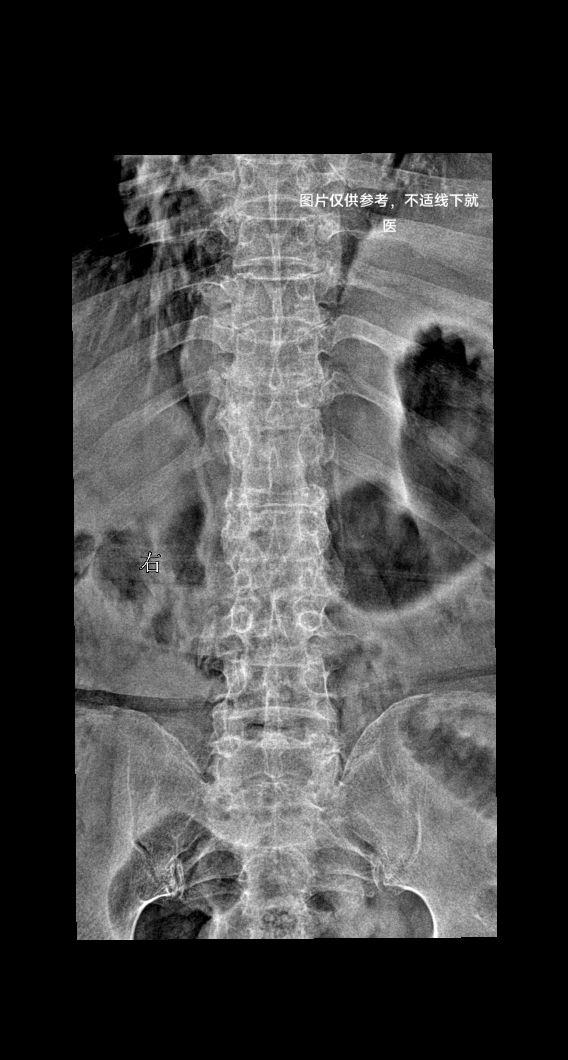 男，79y,腰疼就诊