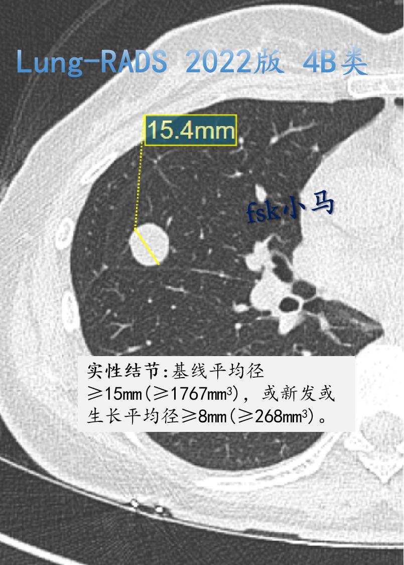 Lung-RADS 2022版 4B类：很可能恶性,人群罹患率约2%。...