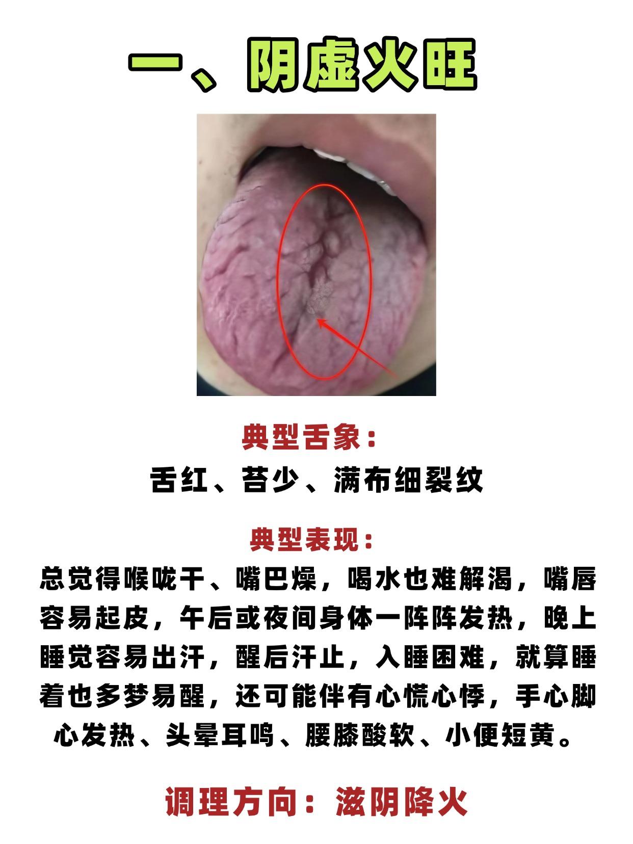 舌头有裂纹？6种原因要知道！