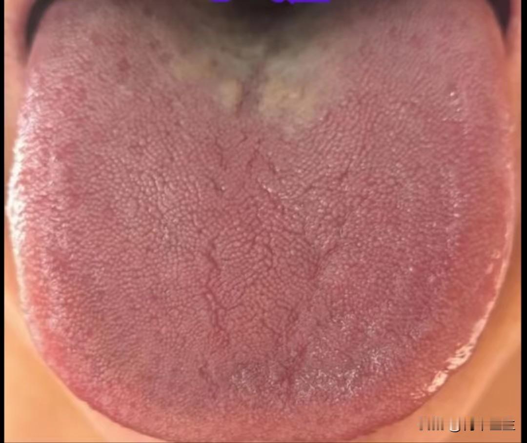 这种舌头，我敢说，80%的人都调错方向了，根本不是瘀血的事

今天面诊的一个小姑