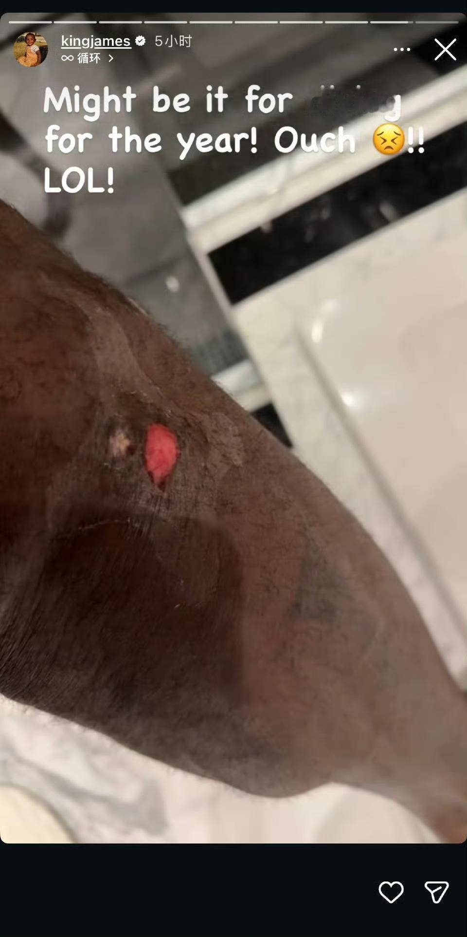 詹姆斯更新动态，晒出自己腿上的伤口并表示：

“那或许是年度最佳倒地救球！疼死了