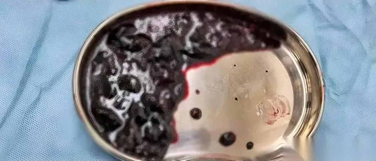 屁股长出“血馒头”？

别笑，下一个可能就是你。

杭州90后小江雪场一屁股坐下