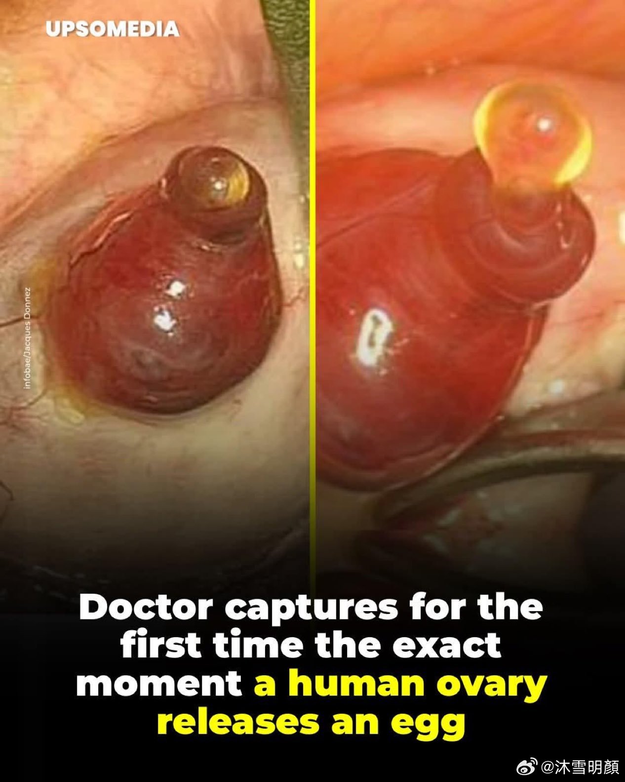 2008年，妇科医生雅克·唐纳兹（Jacques Donnez captured