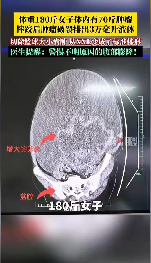 “离大谱！”浙江女子减肥多年，180斤体重纹丝不动，没想到摔了一跤后，肚子突然“