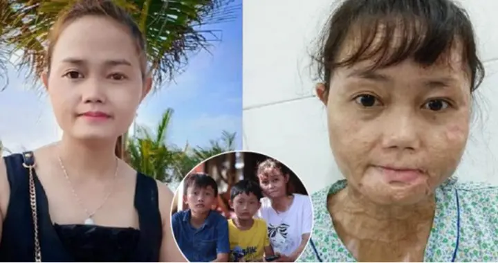 可怜！越南女子被丈夫泼油漆毁容，为了两个孩子坚强求生