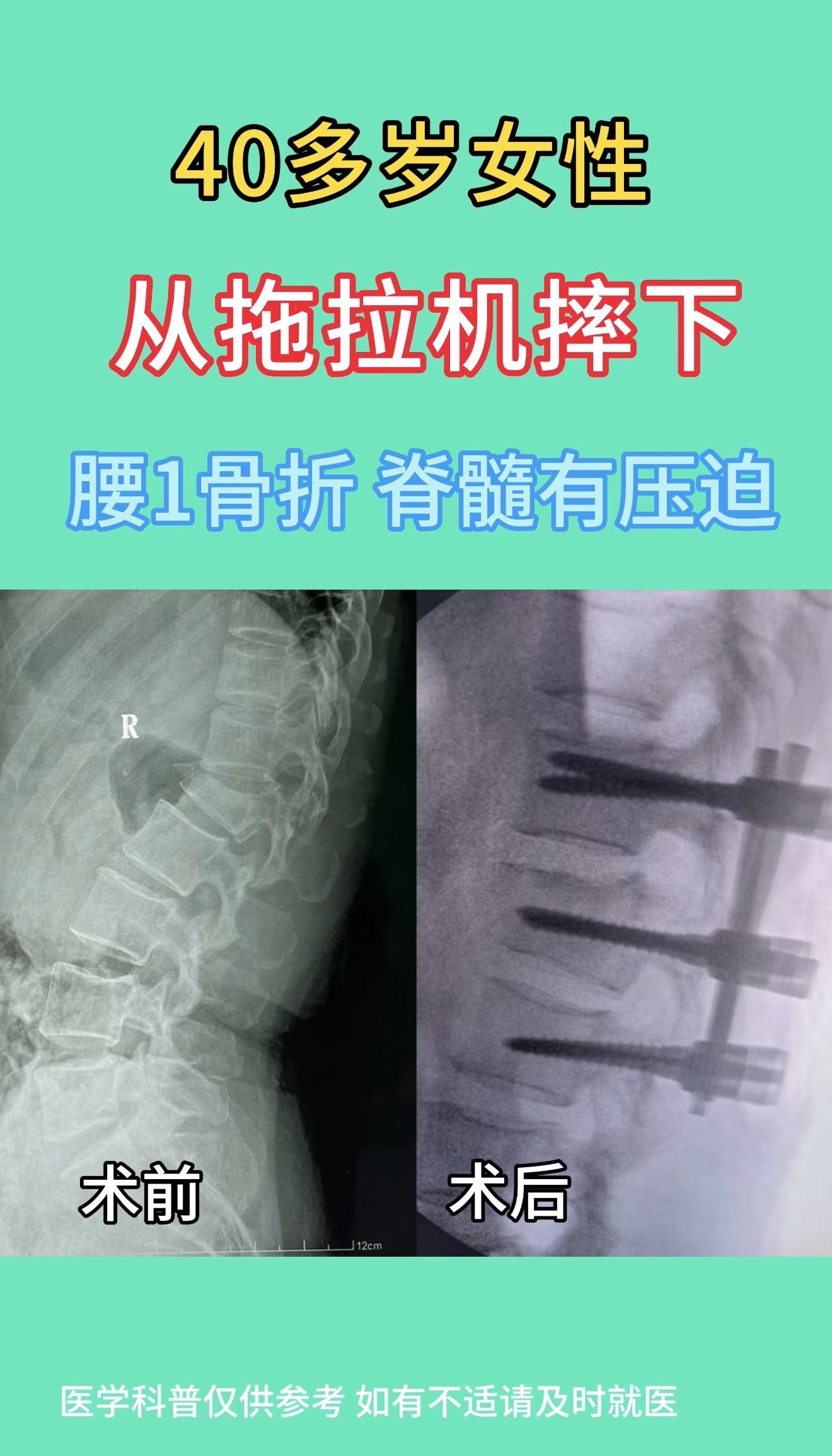 40多岁女性，劳动时从拖拉机上摔下，腰1骨折。磁共振显示脊髓有压迫，但...