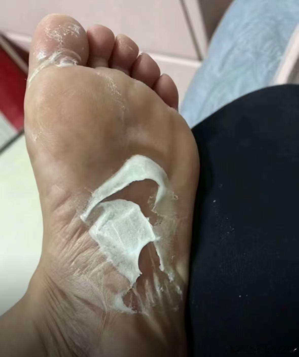 宝宝们我的脚变成这个样子了怎么办