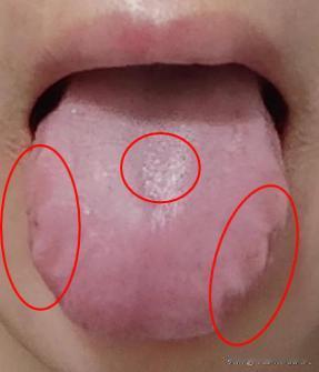 舌头肿胀似“充气”？多是肝脾不和，1盒中成药，排浊气、通中焦
这位粉丝平时总觉得