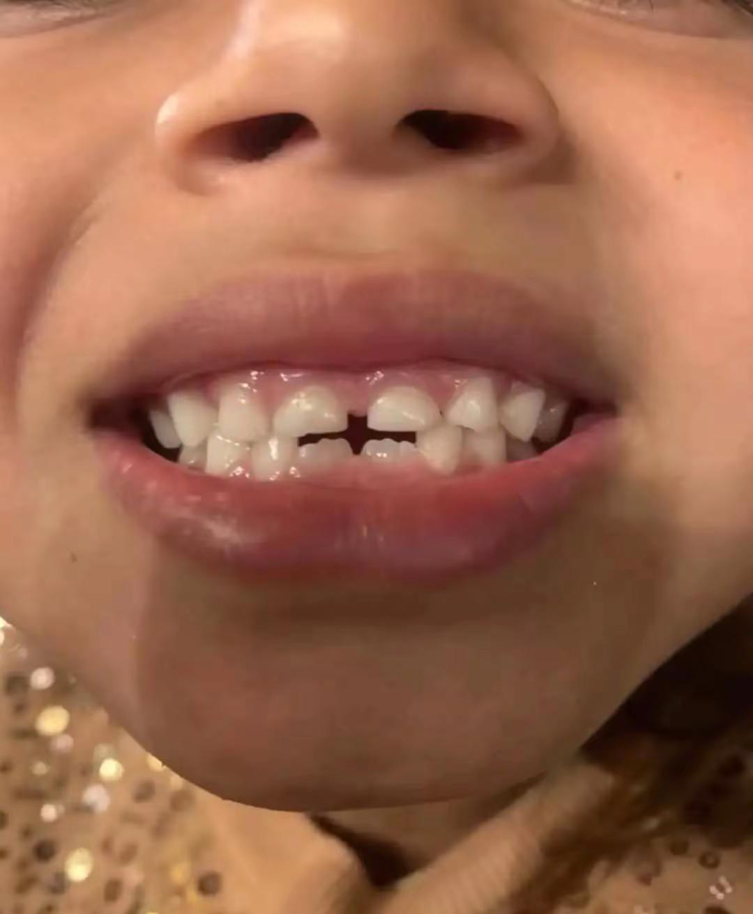 这个孩子乳牙之间的缝隙创造了一个和蝙蝠侠标志一模一样的形状。