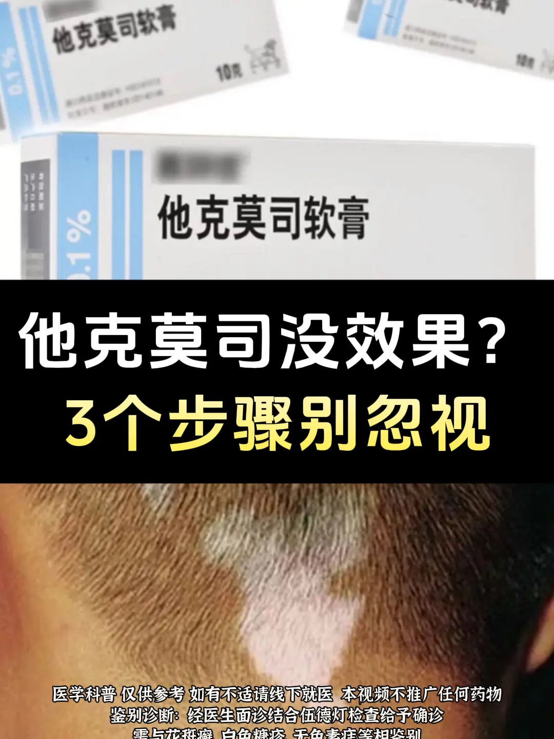 白癜风朋友注意了，他克莫司用后没有效果，这3个步骤不到位，小心白白浪费...