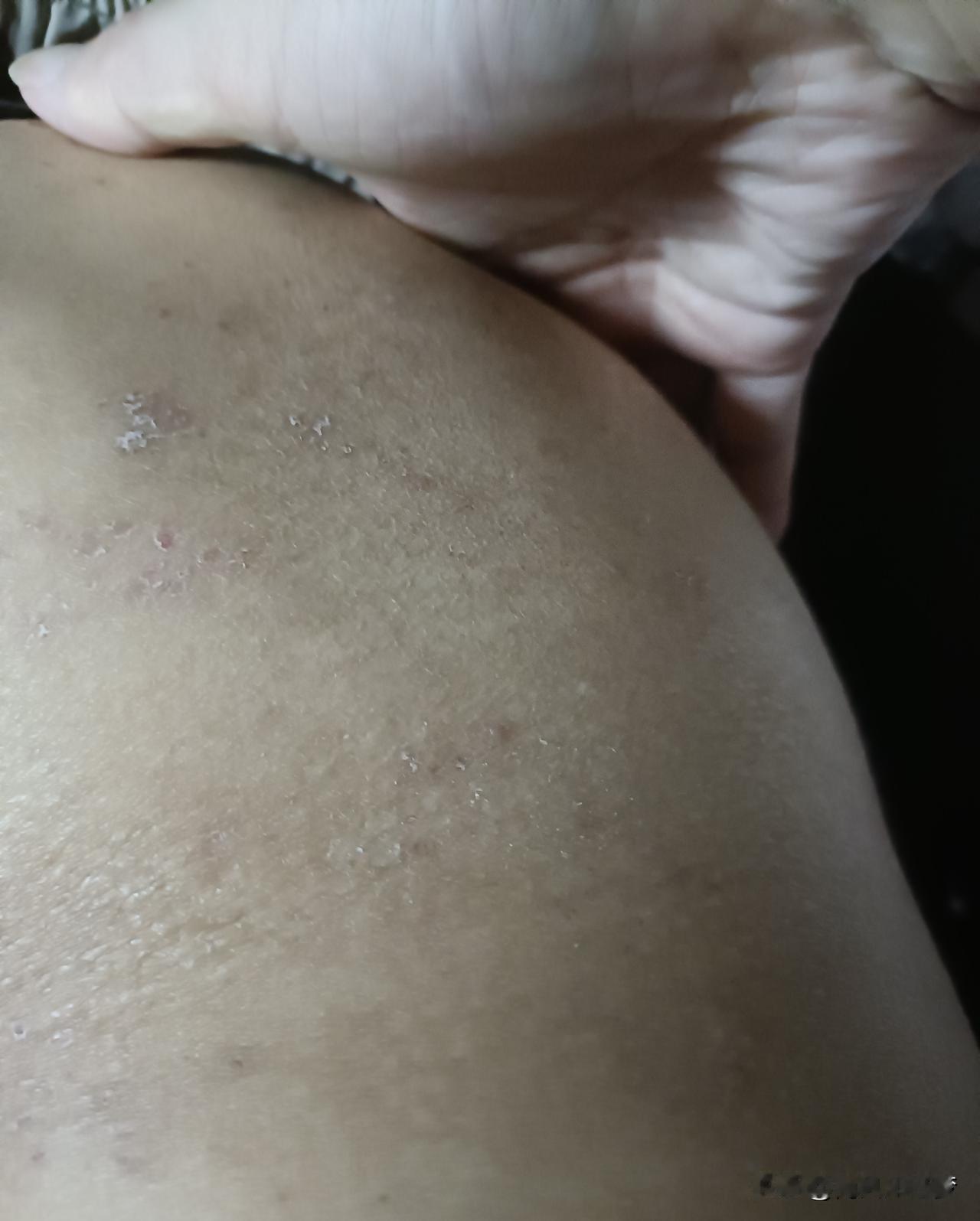 第二周的疱疹


擦剩下的药，吃剩下小药丸


吃后面开的中药，今天也吃完了。
