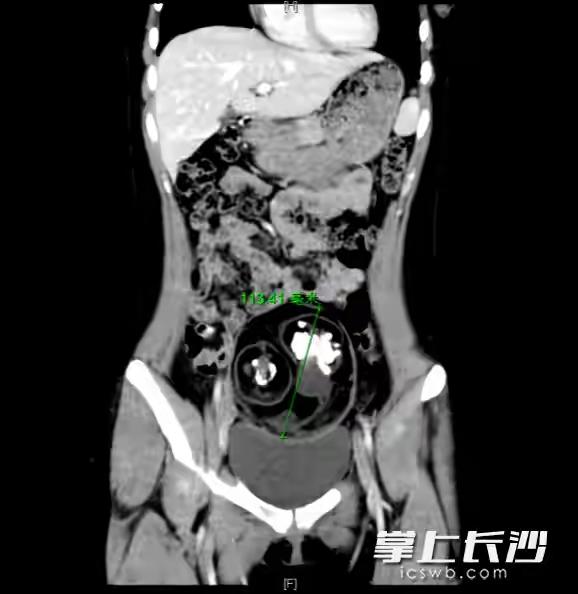 惊讶！18岁女孩腹中取出24颗牙齿，医生说并非“怪胎”
长沙18岁的琳琳（化名）