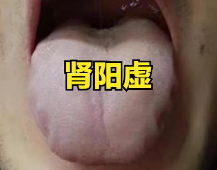三种肾虚，三种调理思路

1. 肾阳虚
舌象：舌质白，舌边有齿痕。
因为肾阳温煦