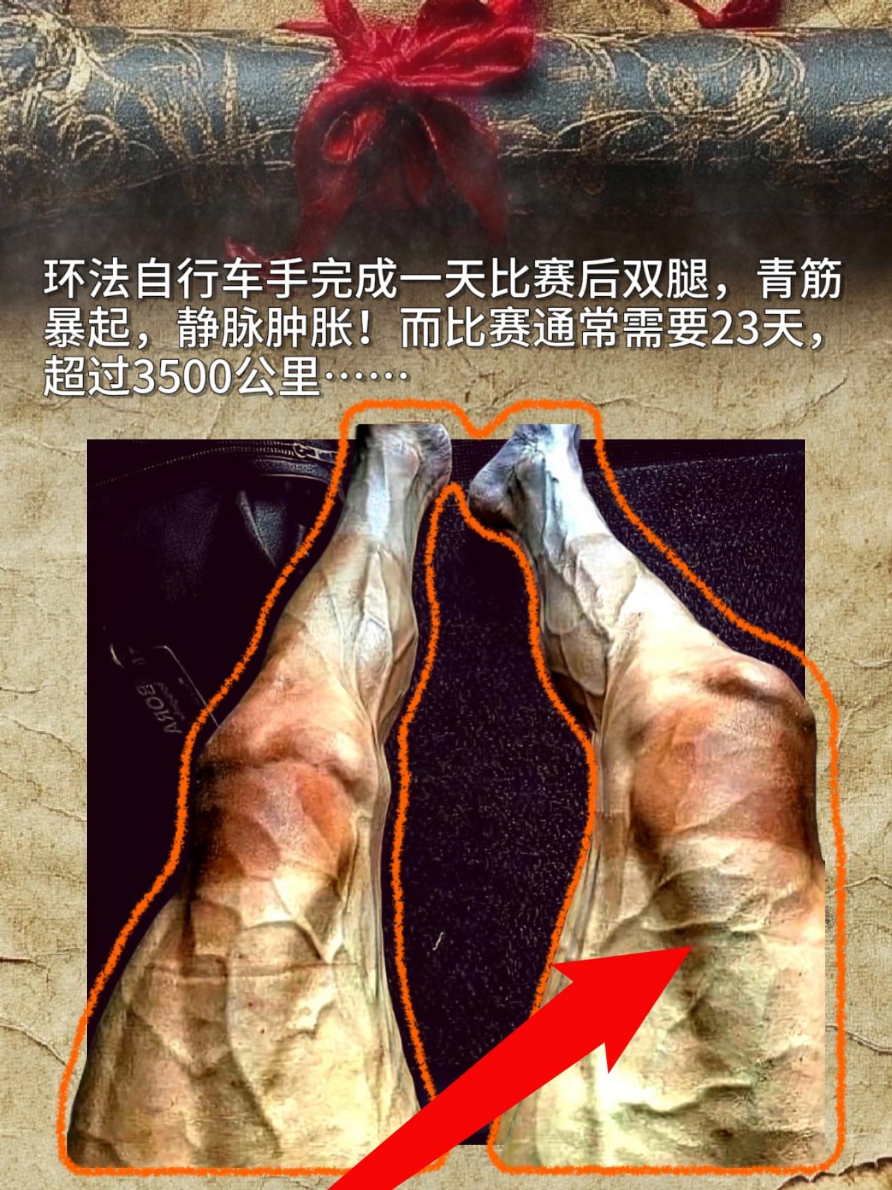 环法自行车手完成一天比赛后双腿，青筋暴起，静脉肿胀！而比赛通常需要23...