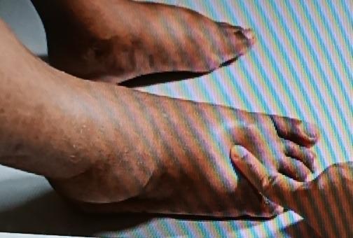 中老年人下肢水肿可太闹心了，不过有几个简易方法能试试。
抬高下肢就是个好办法。晚