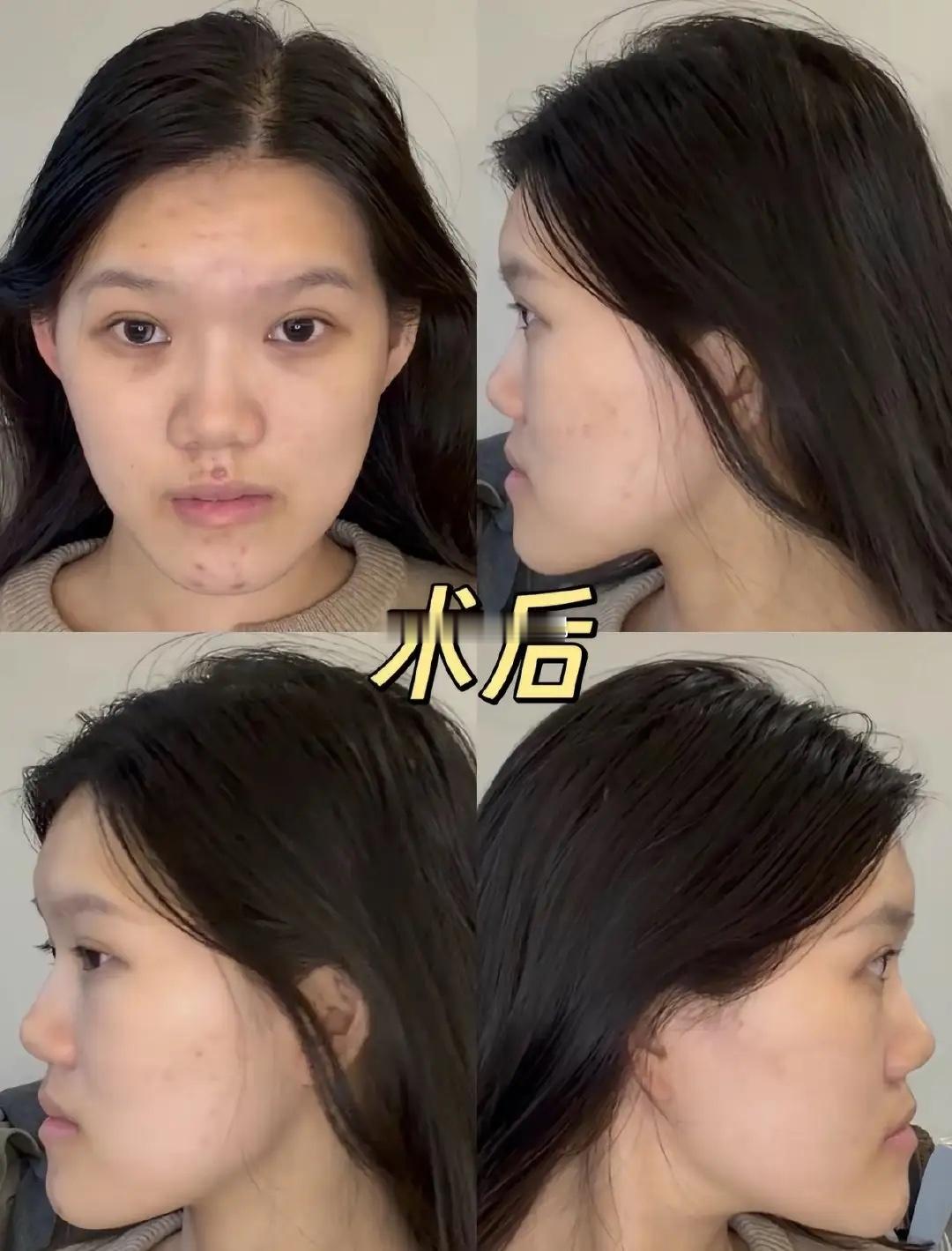 正颌手术方向完全做反，女孩从期待变坠入毁灭女孩满怀憧憬接受正颌手术，本想矫正颌面