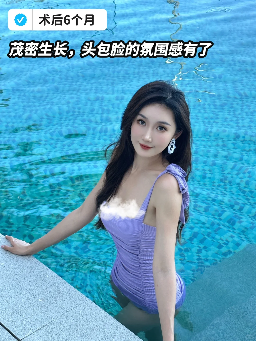 植发日记📓成功上岸功课分享❗️