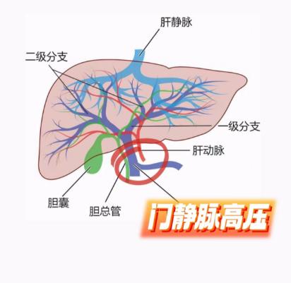 肝硬化患者必看！门静脉高压究竟有多危险！
 
对于肝硬化的朋友们而言，“门静脉高