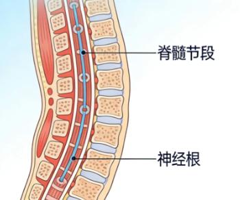 脊髓损伤后像被绳子勒着？是束带感无疑了

很多脊髓损伤的朋友都有过这种感觉：胸口