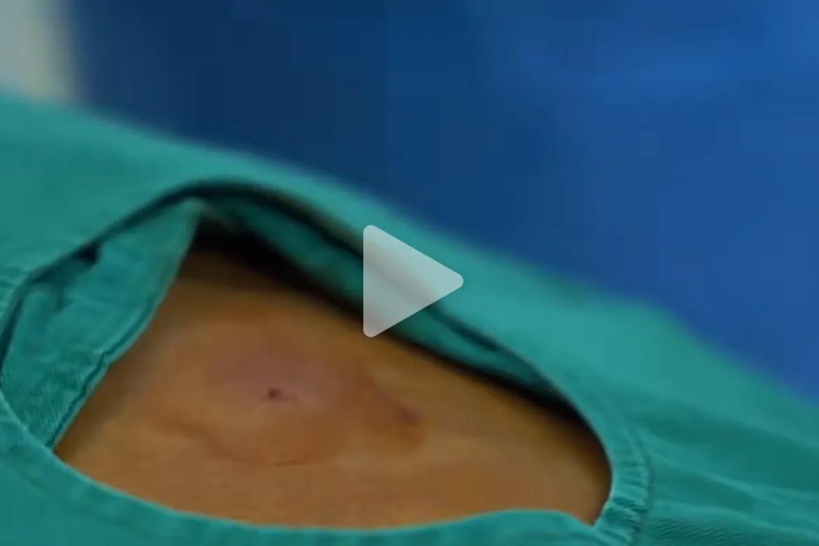 84岁高龄老爷爷，肠癌肝转移，一根 100℃的针直插肿瘤，8分钟完成消融。这个好