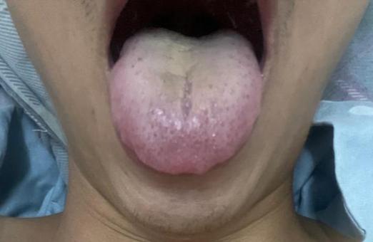 这样的舌象，欲望再强，也要管住手！[给力][给力][给力]


    主诉：欲