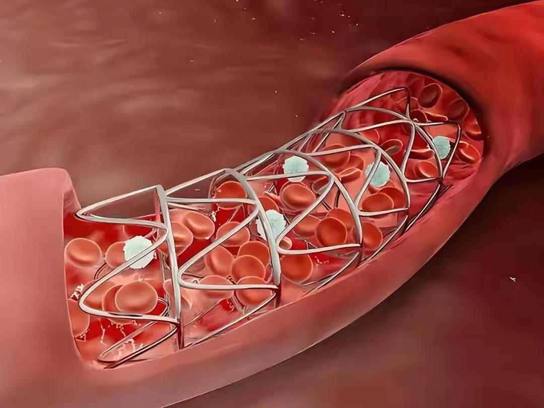 ❤️心梗后坚决不放支架会怎样？医生实话实说：两种结局，没有中间路
——这不是“选