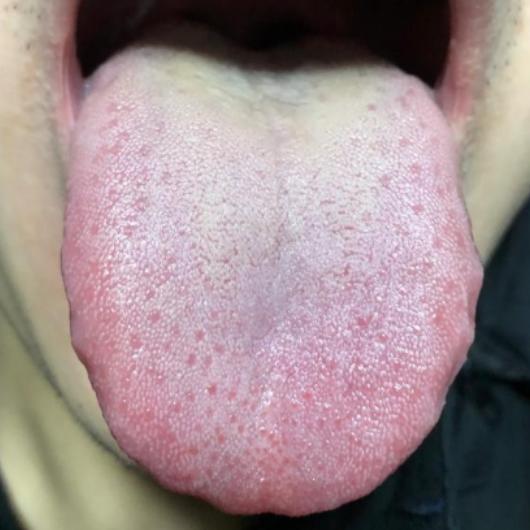 湿气这么重，还不停的进补，这简直是在拿你的身体开玩笑！
 
患者经常感觉手脚冰凉