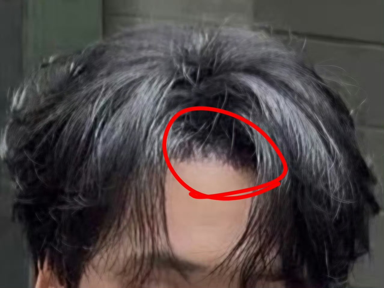梅K少卖点四千八一根的头发吧，看看秃成啥样了，还要去植发🤭 ​​​