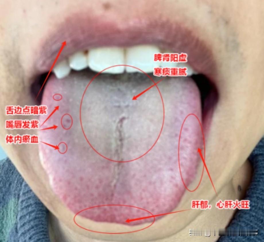 这种舌头千万别光疏肝健脾补肾阳，否则会耽误大事。

患者主诉：总感觉浑身没劲，平