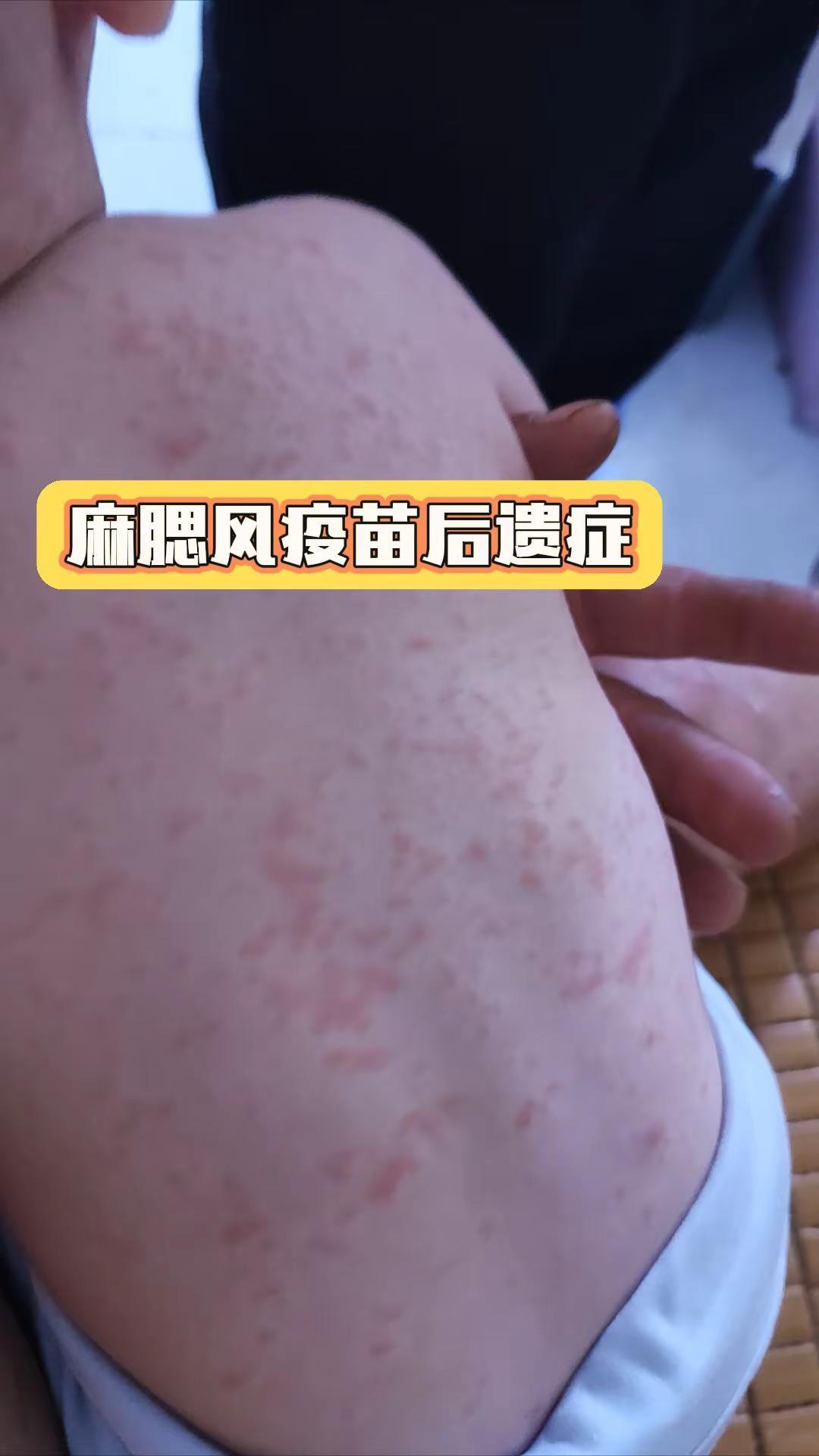 麻腮风疫苗后遗症太折腾人了...
