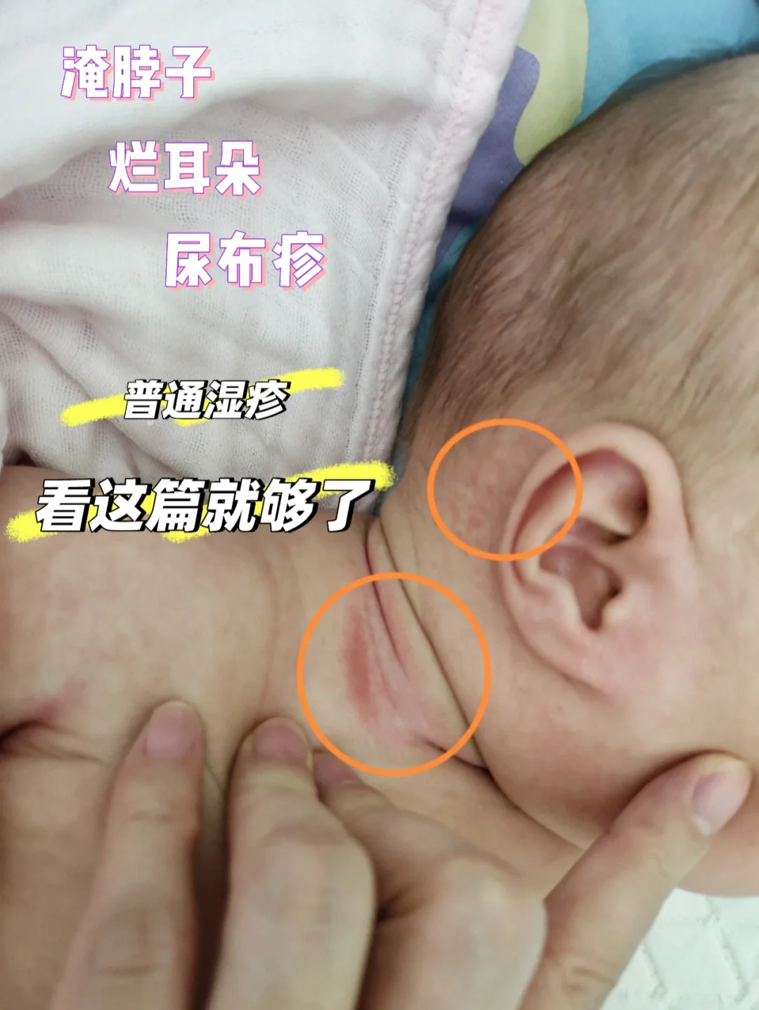 被宝宝湿疹困扰一定要看这篇，非常实用