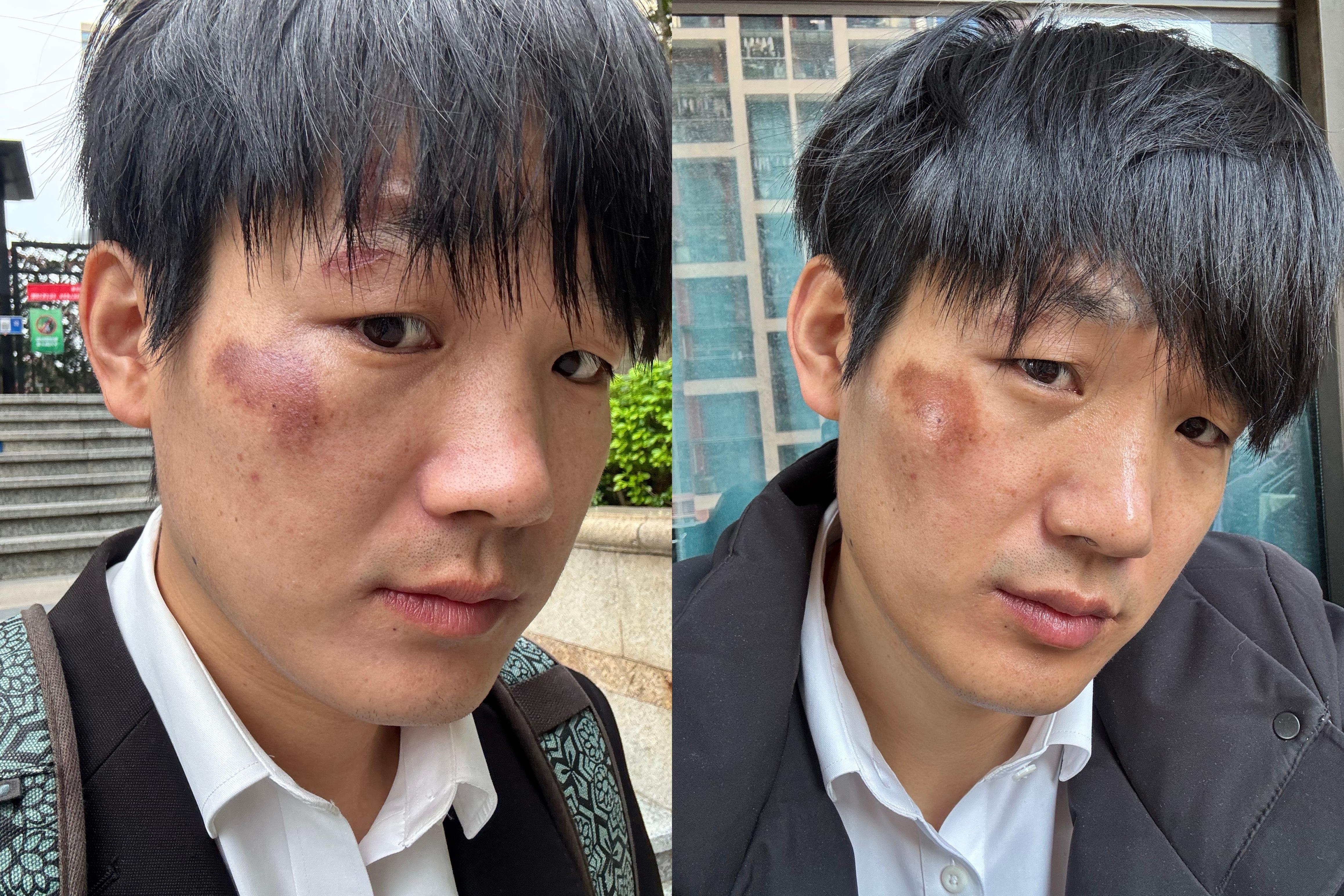 脸上的擦伤留下的色素沉着，由黑色变为褐色了，已经慢慢褪色了，我现在每天照镜子几十
