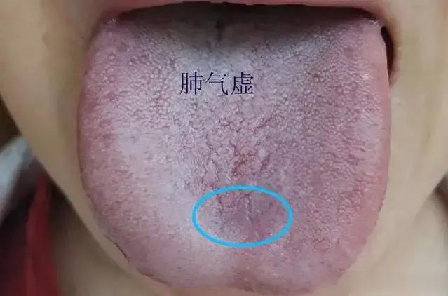 舌头有裂纹，你虚的不止一点。1、肺阴不足：裂纹容易出现在前1/3或舌前1/2的位
