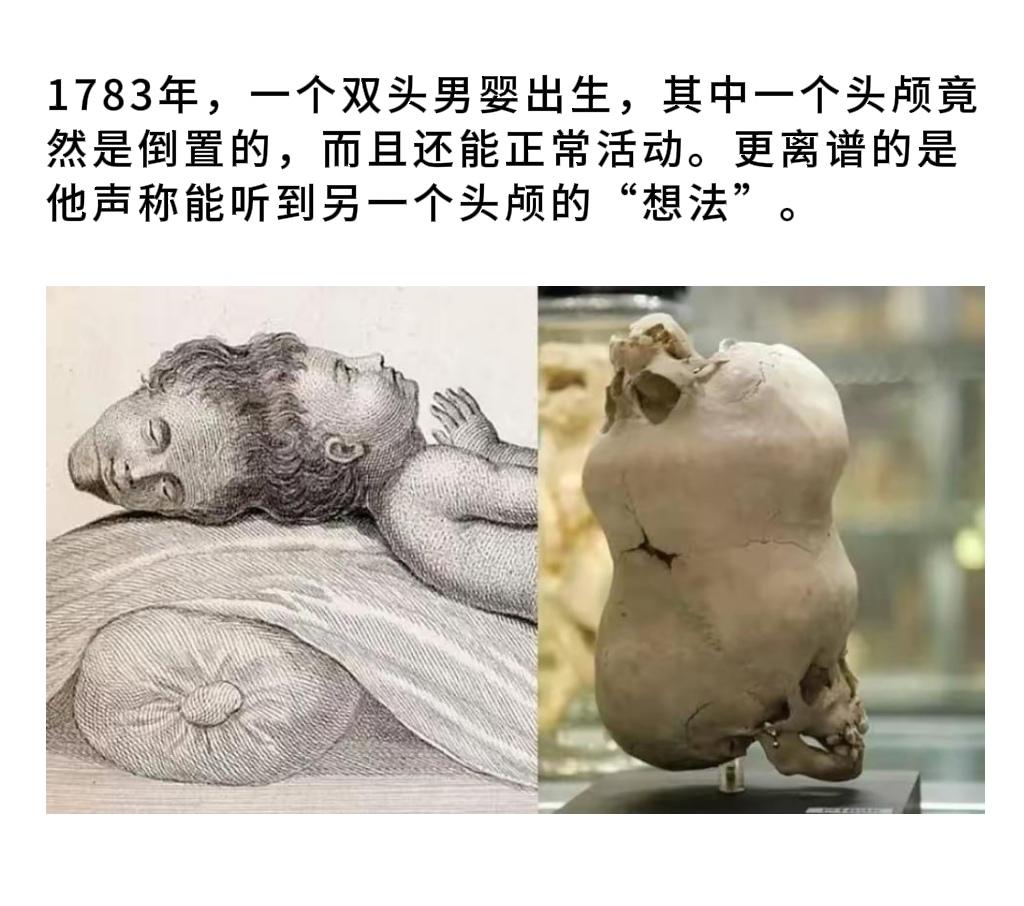 1783年，一个双头男婴出生，其中一个头颅竟然是倒置的，而且还能正常活动。