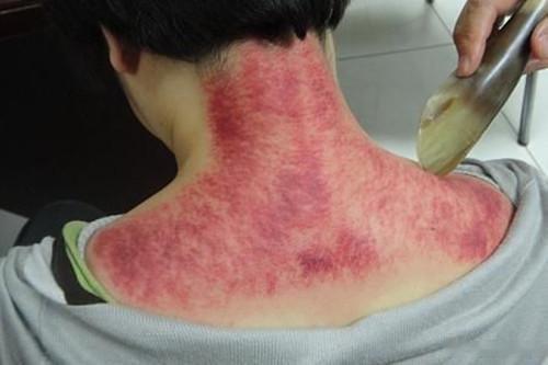 痧.是什么？离经之血！结节是什么？气血瘀滞物！癌是什么？是长时间瘀滞物变异的结果