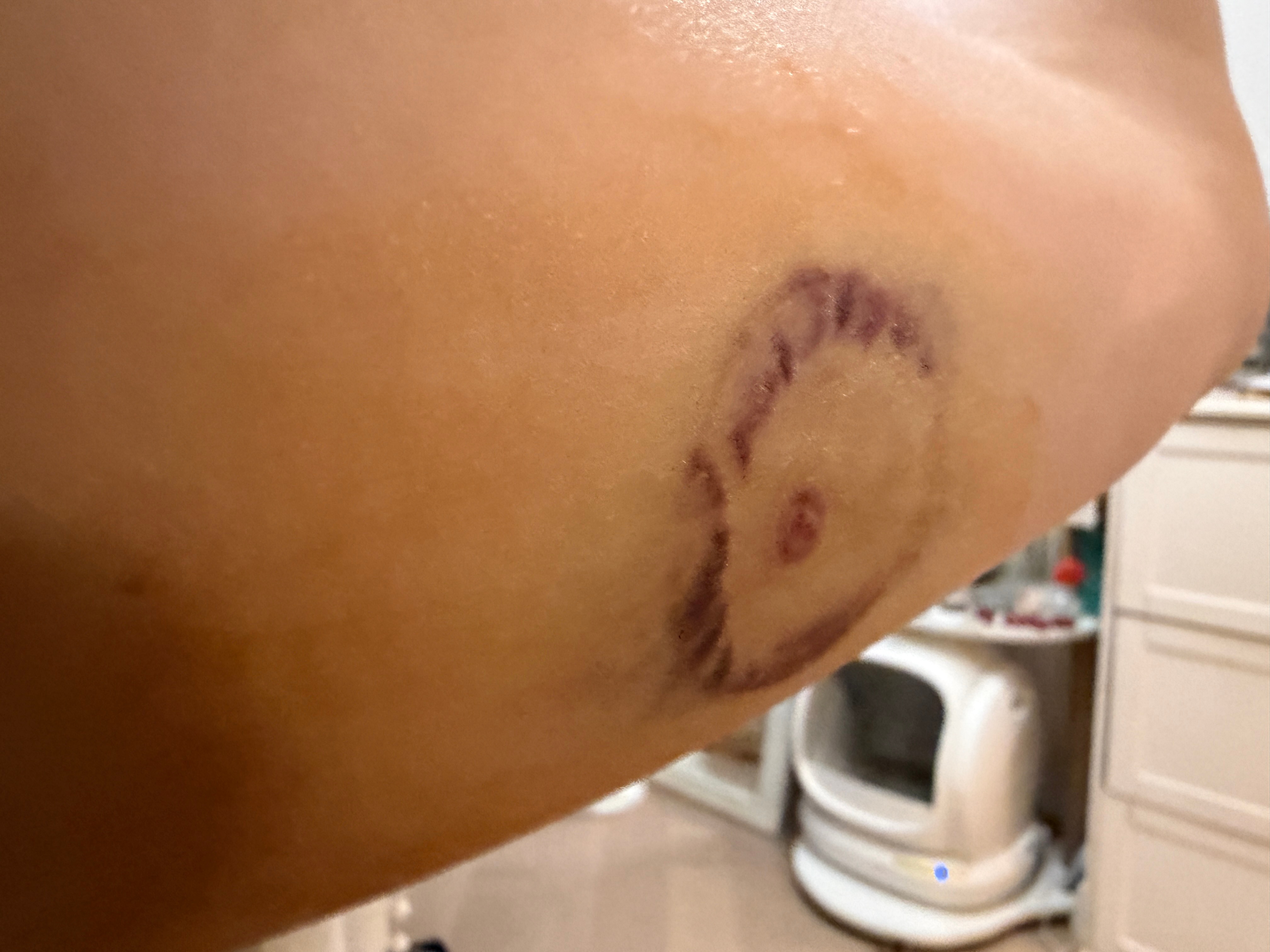怎么做到扎个动态血糖仪把自己弄成这样的……I’m totally amazed 