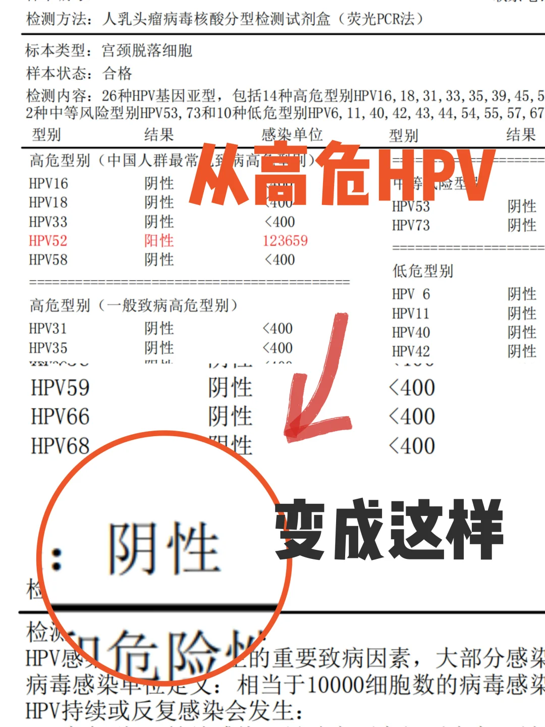 高危hpv，坚持定量hpv检查成功转阴