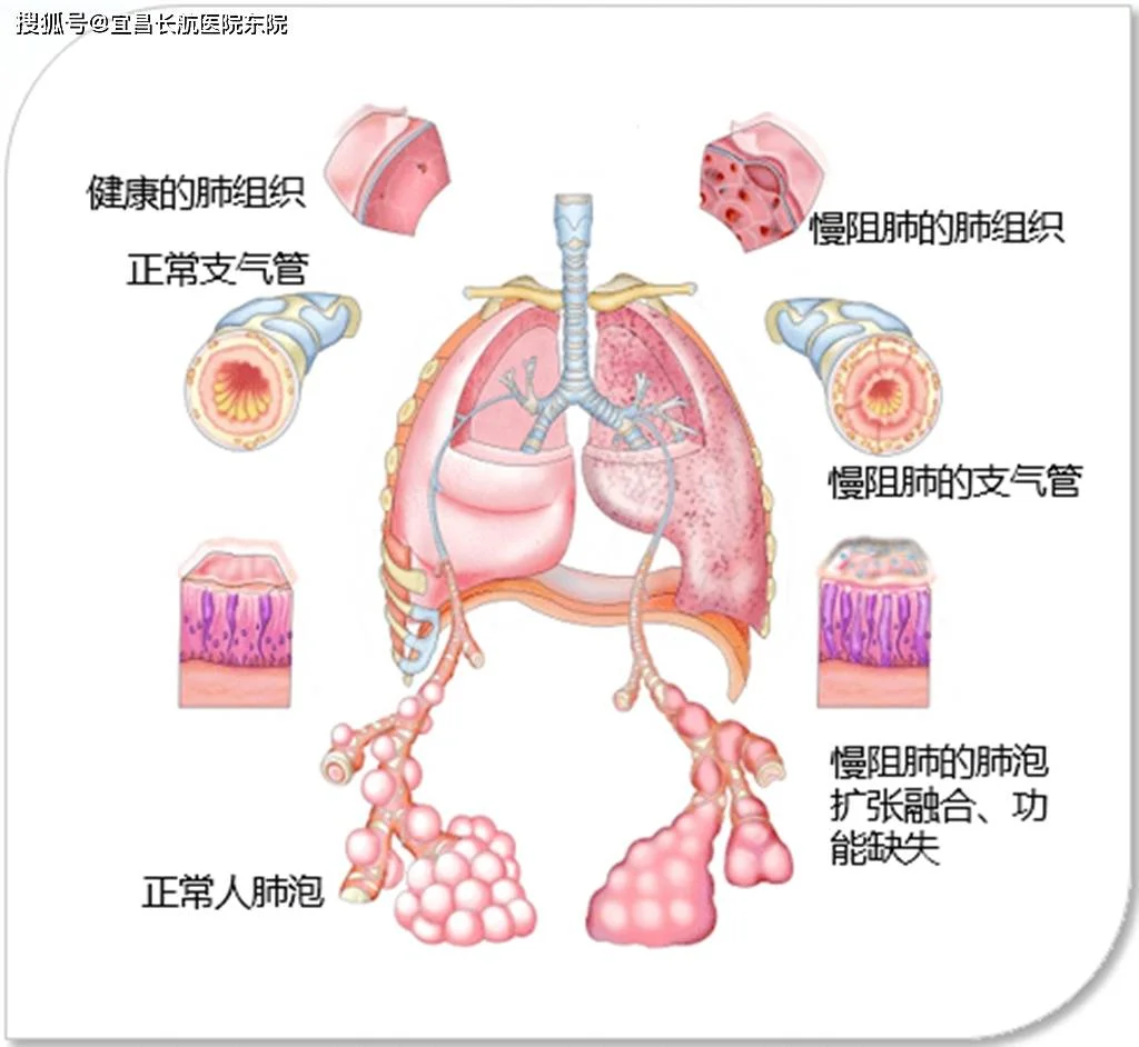 许多人疑惑，中医治疗慢阻肺是不是太慢了？