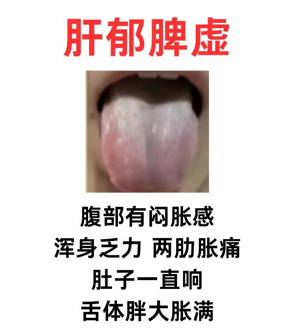 舌象看脾胃：6 种脾虚舌象对照自查