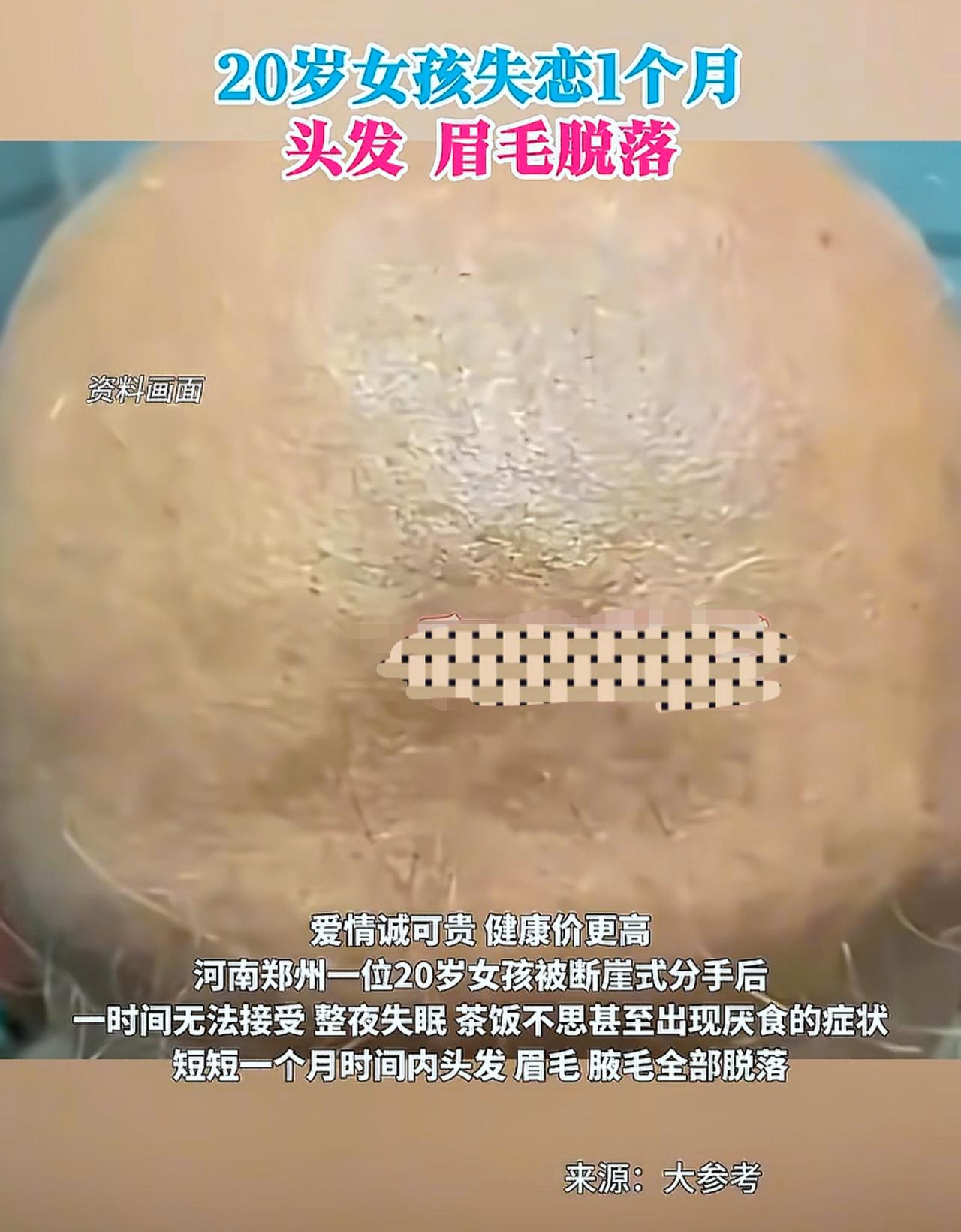 问世间情为何物。

河南郑州20岁女孩被断崖式分手后，
一个月头发、眉毛、腋毛全
