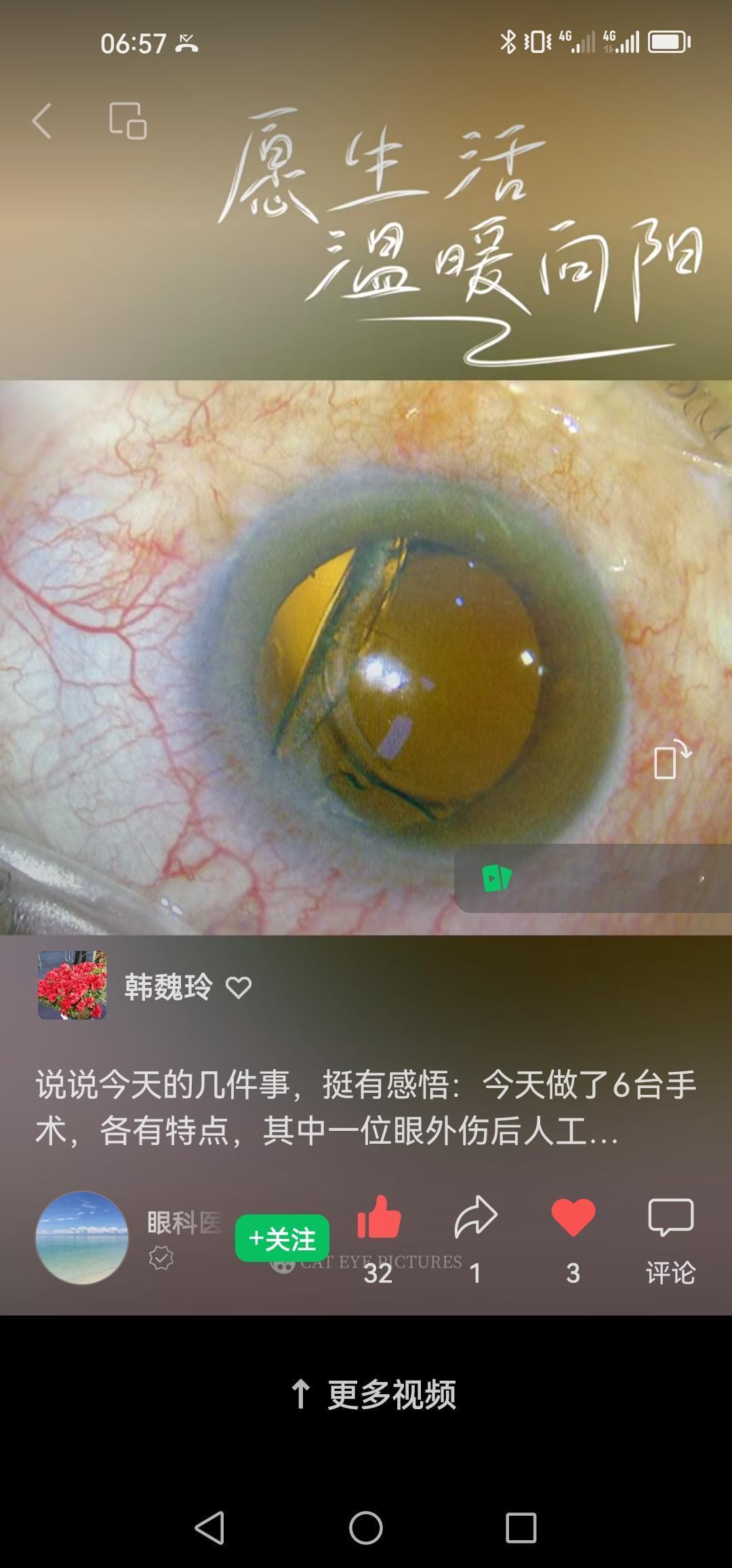 说说今天的几件事，挺有感悟。
今天做了6台手术，各有特点，其中一位眼外伤后人工晶