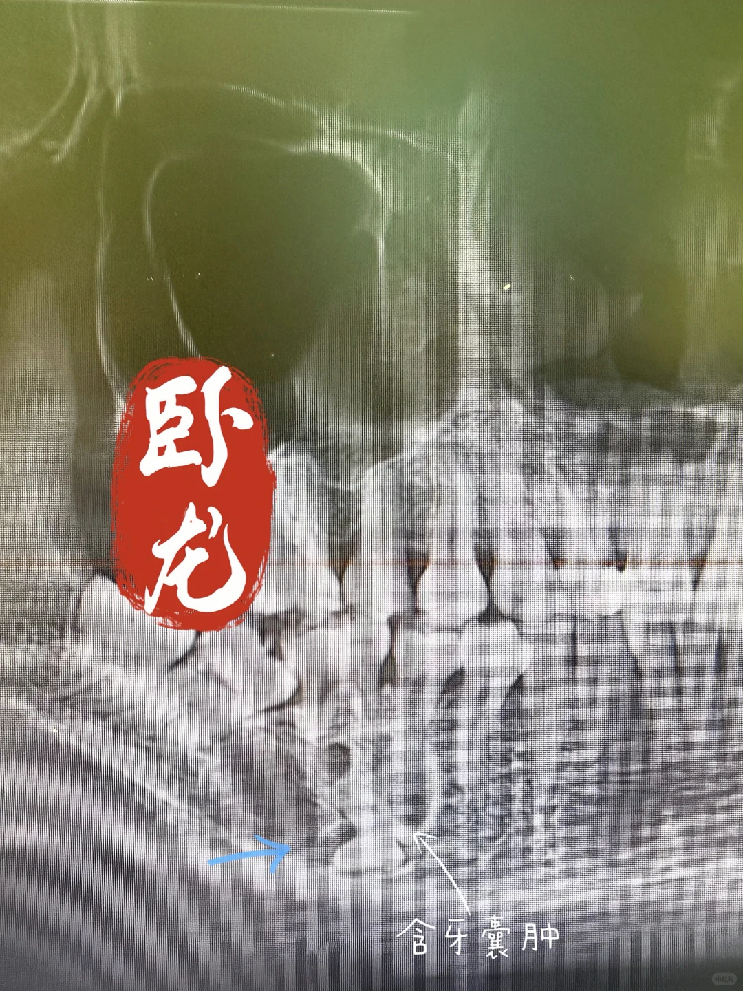 拔牙~有卧龙的地方必有凤雏！